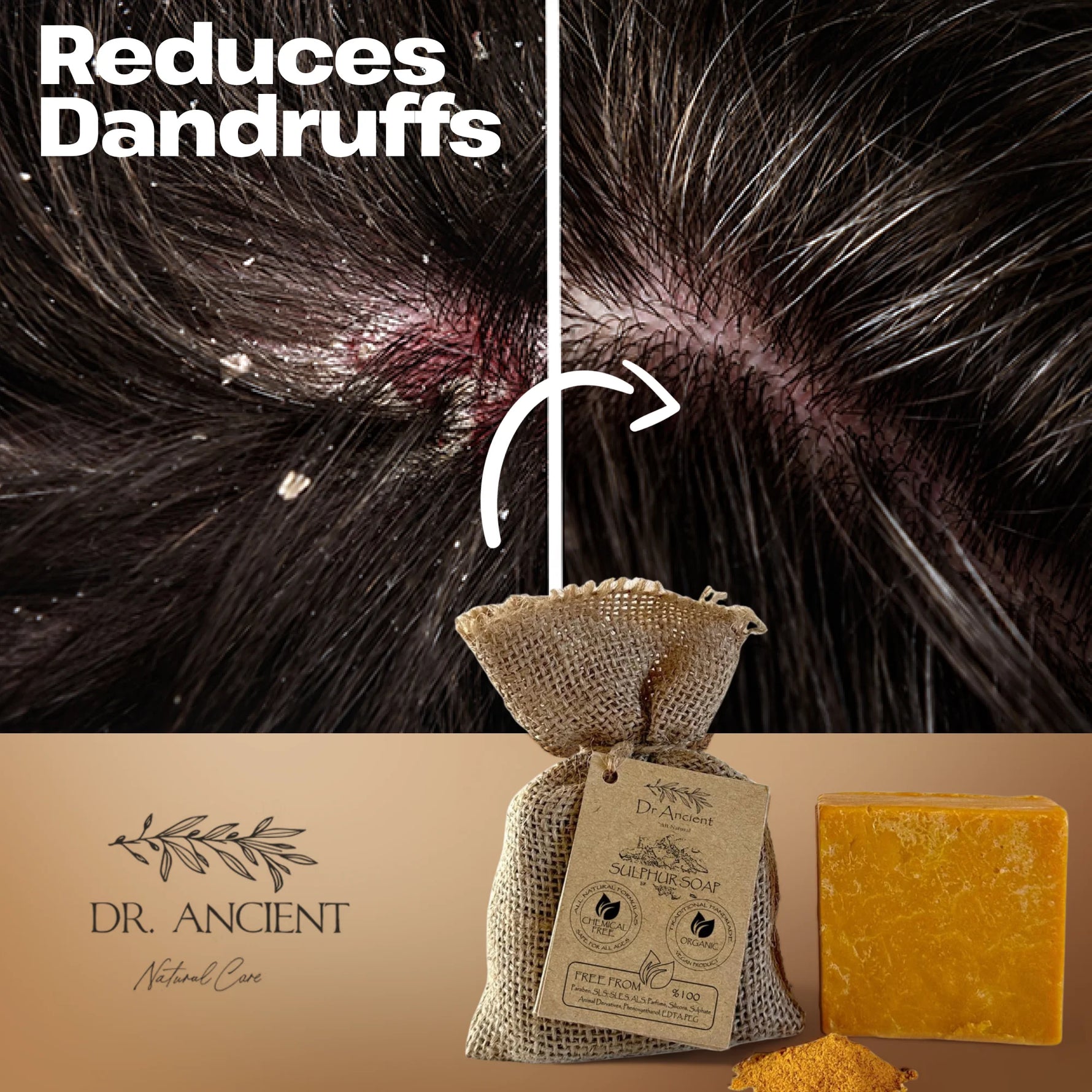 A split promotional graphic for a natural dandruff treatment. The top half shows a close-up of a scalp with dandruff flakes, with the text 'Reduces Dandruffs' and a white arrow pointing toward a clearer scalp.